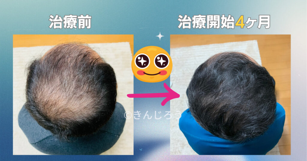 After-4-month-of-minoxidil-use-top