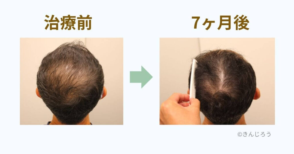 銀クリのAGA治療7ヶ月で頭頂部の薄毛が改善したビフォーアフター写真