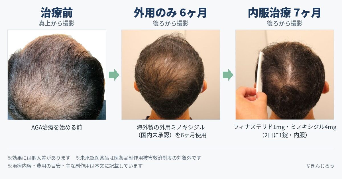 治療前・外用ミノキシジル6ヶ月後・内服治療7ヶ月後の比較
