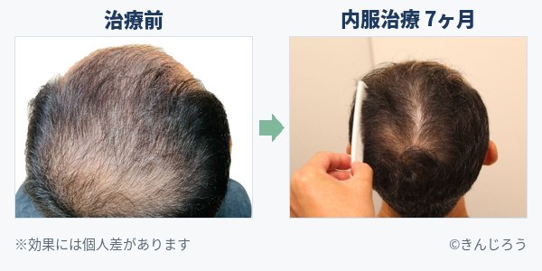 治療前と内服治療7ヶ月後の比較