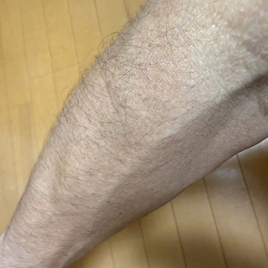 ミノキシジルの内服を続けた現在の同じ前腕の毛の状態
